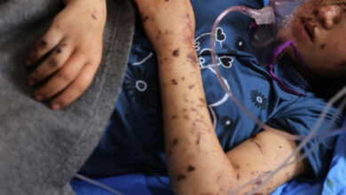 „Ich will meine Beine zurück“: Amputierte Kinder in Gaza
